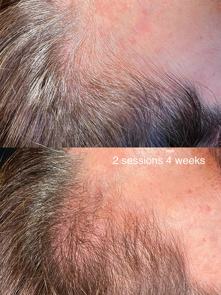 infinique-hair-restoration-7